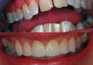 before and after dental treatment