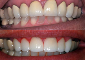 before and after dental treatment