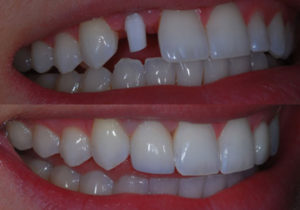 before and after dental treatment