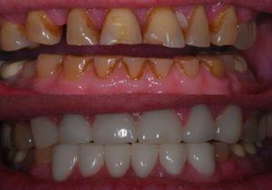 before and after dental treatment