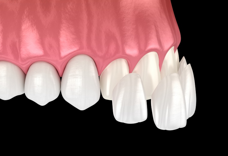 3D illustration of veneers being placed on upper teeth during a cosmetic procedure in Brookfield, WI