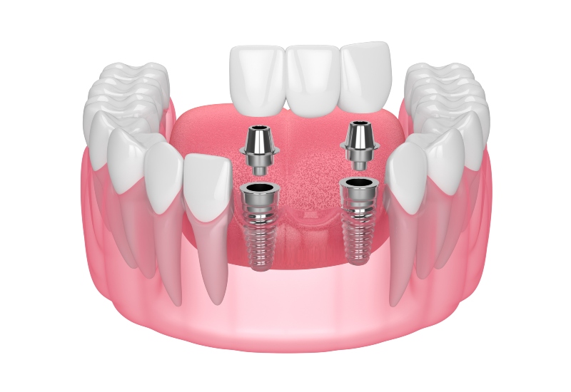 A 3D model of Dental Crowns and Bridges in Brookfield, WI, with implants placed in the upper jaw