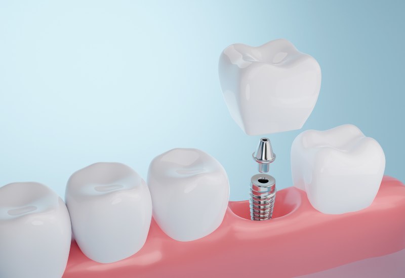 3D image of dental implant with crown, abutment, and post replacing tooth in Brookfield, WI