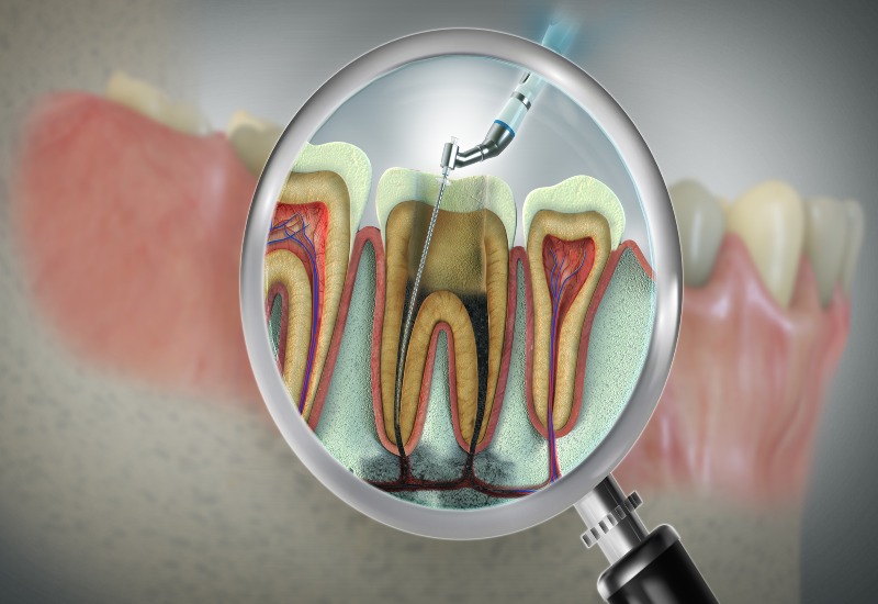 A magnified view of a tooth cross-section showing root canal treatment in Brookfield, WI