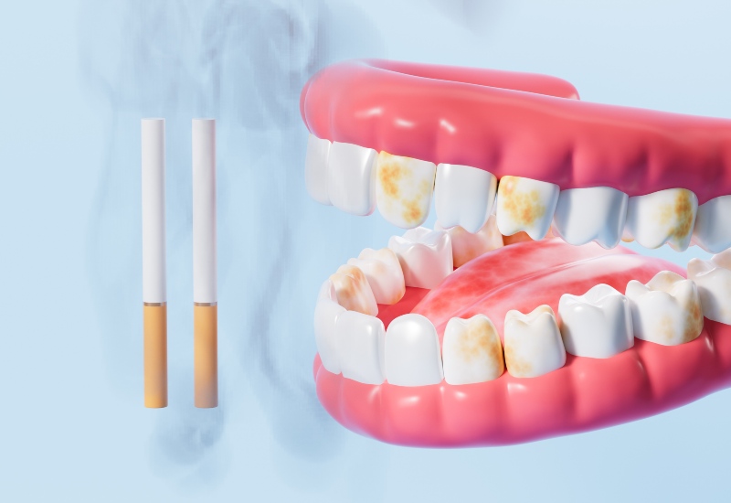 Stained teeth & cigarettes show the increased risk of gum disease from smoking in Brookfield, WI