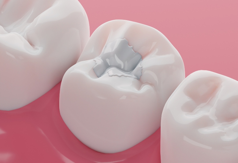 A close-up of a molar with a tooth-colored filling, showcasing dental care in Brookfield, WI